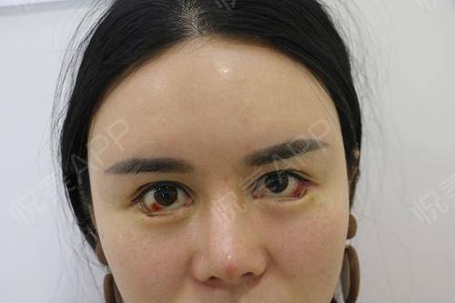 双眼皮手术开眼角和后眼角_眼角上扬的人面相_开眼角对面相的影响